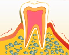 歯周病初期の症状