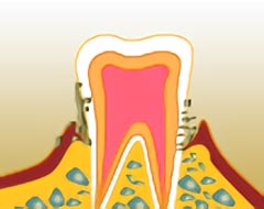 中期に進行した歯周病のイメージ
