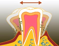 歯周病の末期症状